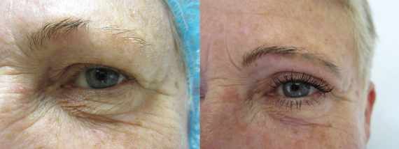 Operace očních víček před a po