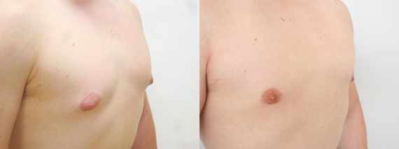 Před a po zmenšení prsou u mužů - gynekomastie
