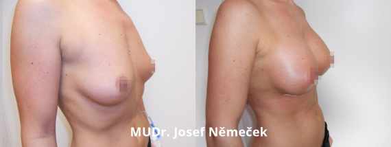 Foto před a po zvětšení prsou