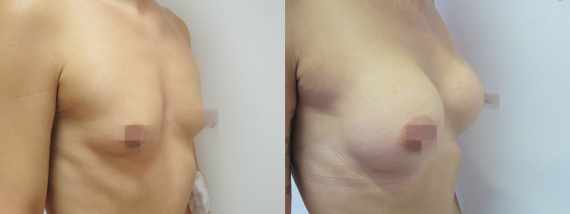 Foto před a po zvětšení prsou