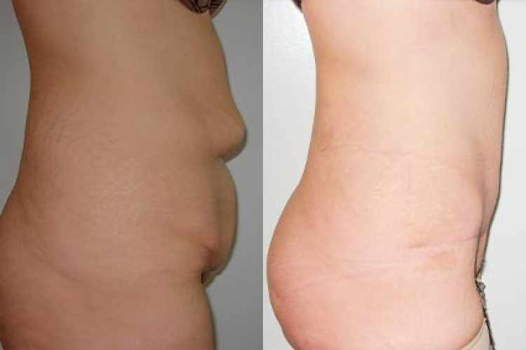 Fotogalerie před a po plastika břicha (Abdominoplastika)