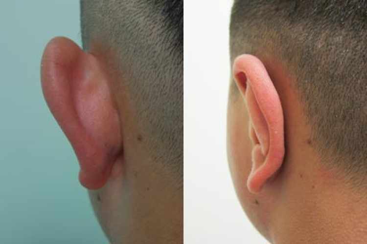 Plastika uší před a po