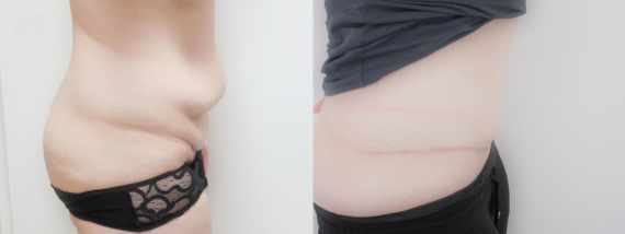 plastika břicha (Abdominoplastika) před a po