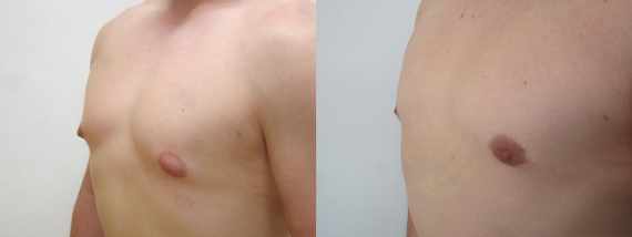 Před a po zmenšení prsou u mužů - gynekomastie