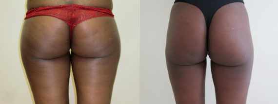 Liposukce před a po vnitřní stehna