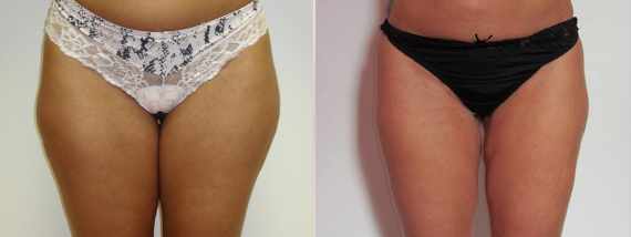 Liposukce před a po vnitřní stehna