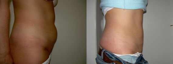 Foto před a po liposukce