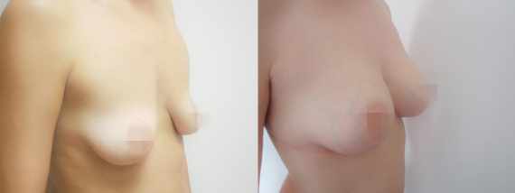 Fotogalerie - modelace prsou před a po