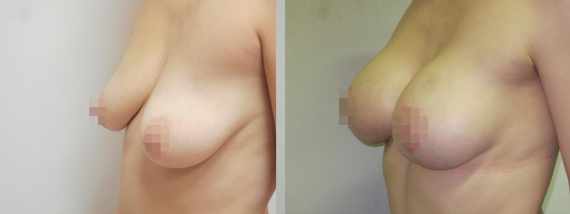 Augmentace s modelací prsou