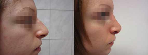 Operace nosu před a po