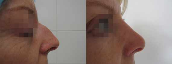 Operace nosu před a po