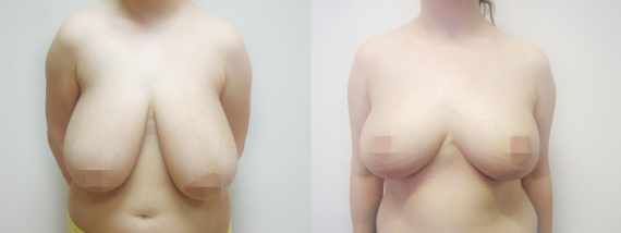 Před a po zmenšení prsou