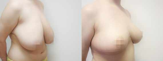 Před a po zmenšení prsou