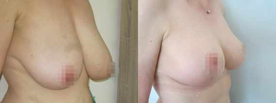 zmenšení prsou před a po